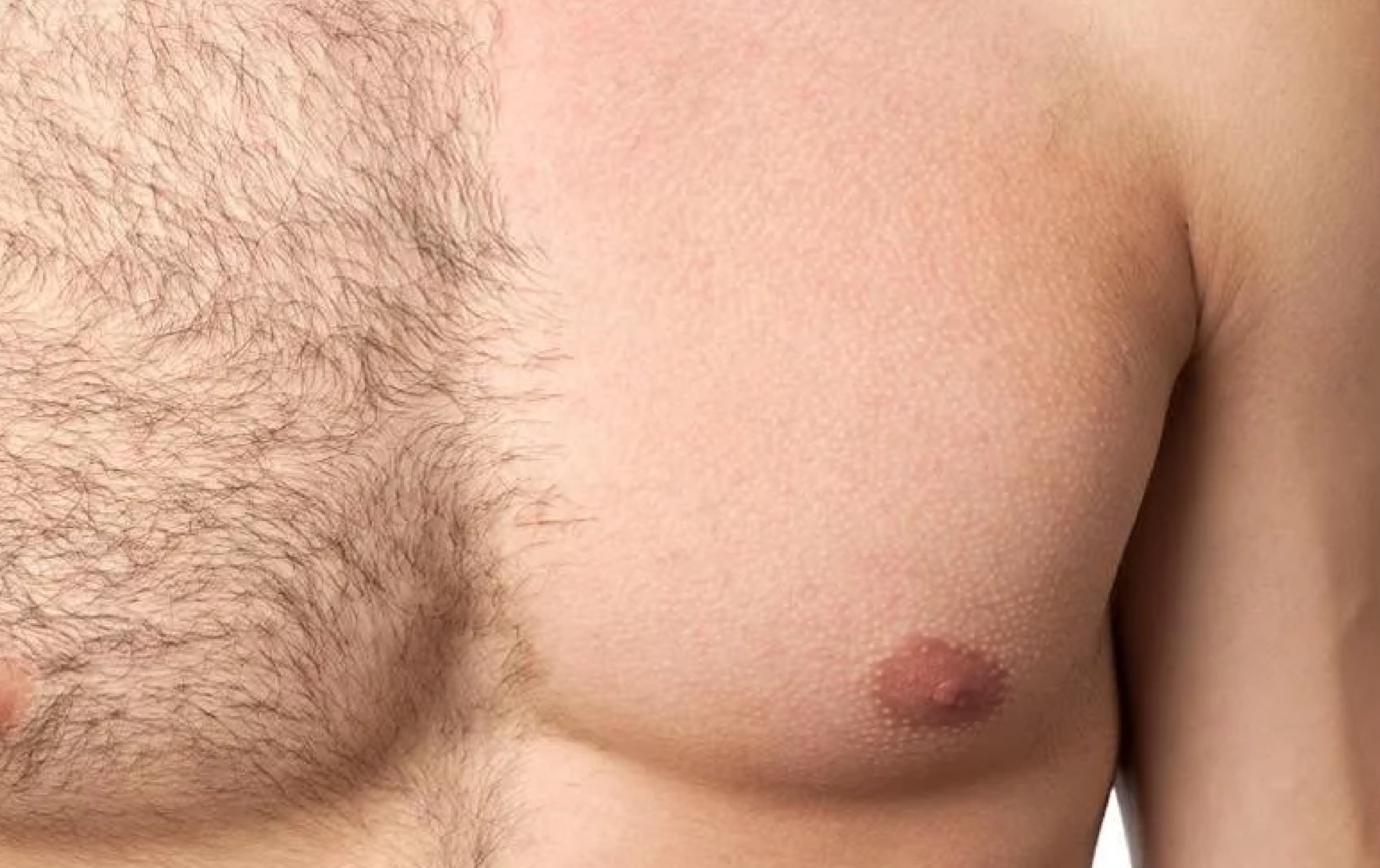 Men’s Laser Hair Removal